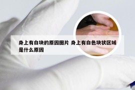 身上有白块的原因图片 身上有白色块状区域是什么原因