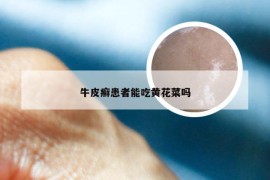 牛皮癣患者能吃黄花菜吗