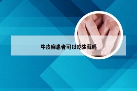 牛皮癣患者可以吃生蒜吗