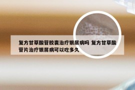 复方甘草酸苷胶囊治疗银屑病吗 复方甘草酸苷片治疗银屑病可以吃多久