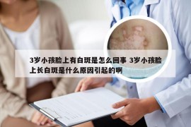 3岁小孩脸上有白斑是怎么回事 3岁小孩脸上长白斑是什么原因引起的啊
