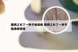 胳膊上长了一块干燥像癣 胳膊上长了一块干燥像癣很痒