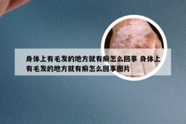 身体上有毛发的地方就有癣怎么回事 身体上有毛发的地方就有癣怎么回事图片