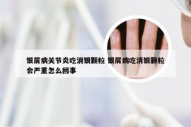 银屑病关节炎吃消银颗粒 银屑病吃消银颗粒会严重怎么回事