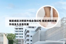 银屑病首次照紫外线会发红吗 银屑病照射紫外线多久会有效果