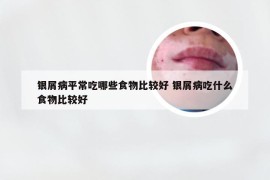 银屑病平常吃哪些食物比较好 银屑病吃什么食物比较好
