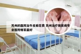 苏州的医院治牛皮癣花费 苏州治疗银屑病专业医院哪家最好