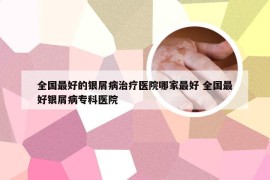 全国最好的银屑病治疗医院哪家最好 全国最好银屑病专科医院