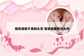 银屑病用不用剃头发 银屑病要勤洗头吗