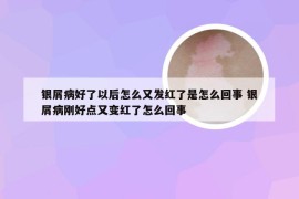 银屑病好了以后怎么又发红了是怎么回事 银屑病刚好点又变红了怎么回事