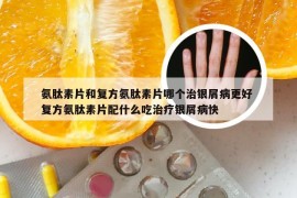 氨肽素片和复方氨肽素片哪个治银屑病更好 复方氨肽素片配什么吃治疗银屑病快