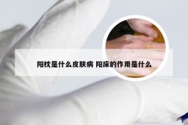 阳枕是什么皮肤病 阳床的作用是什么