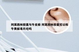阿莫西林胶囊与牛皮癣 阿莫西林胶囊可以和牛黄解毒片吃吗
