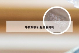 牛皮癣会引起脚腕疼吗