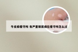 牛皮癣看守所 有严重银屑病在看守所怎么过