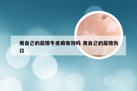 用自己的尿擦牛皮癣有效吗 用自己的尿擦伤口