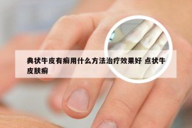 典状牛皮有癣用什么方法治疗效果好 点状牛皮肤癣