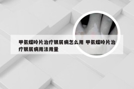 甲氨蝶呤片治疗银屑病怎么用 甲氨蝶呤片治疗银屑病用法用量