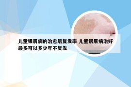儿童银屑病的治愈后复发率 儿童银屑病治好最多可以多少年不复发
