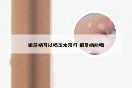 银屑病可以喝玉米须吗 银屑病能喝