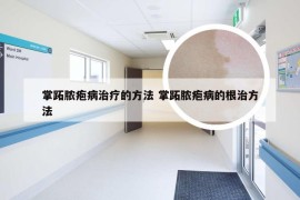 掌跖脓疱病治疗的方法 掌跖脓疱病的根治方法