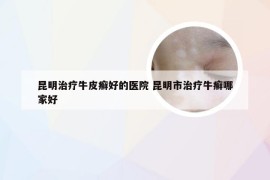 昆明治疗牛皮癣好的医院 昆明市治疗牛癣哪家好