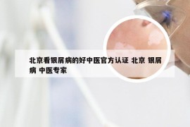 北京看银屑病的好中医官方认证 北京 银屑病 中医专家