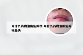 用什么药物治癣能除根 用什么药物治癣能除根最快