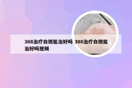 308治疗白斑能治好吗 308治疗白斑能治好吗视频