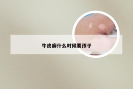 牛皮癣什么时候要孩子