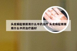 头皮癣起银屑用什么中药治疗 头皮癣起银屑用什么中药治疗最好