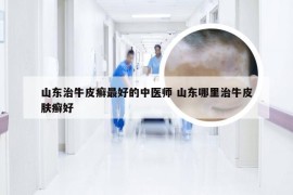 山东治牛皮癣最好的中医师 山东哪里治牛皮肤癣好