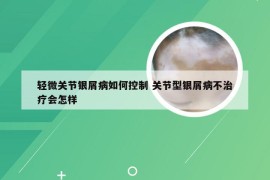 轻微关节银屑病如何控制 关节型银屑病不治疗会怎样