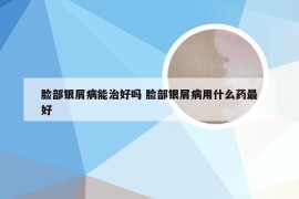 脸部银屑病能治好吗 脸部银屑病用什么药最好