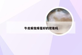 牛皮癣变痒是好的现象吗