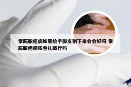 掌跖脓疱病如果给手脚皮割下来会会好吗 掌跖脓疱病脓包扎破行吗