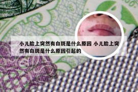 小儿脸上突然有白斑是什么原因 小儿脸上突然有白斑是什么原因引起的