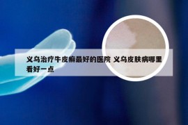 义乌治疗牛皮癣最好的医院 义乌皮肤病哪里看好一点