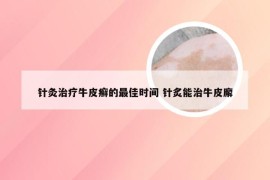 针灸治疗牛皮癣的最佳时间 针炙能治牛皮廨