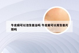 牛皮癣可以泡生姜浴吗 牛皮廨可以用生姜片擦吗