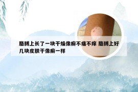 胳膊上长了一块干燥像癣不痛不痒 胳膊上好几块皮肤干像癣一样