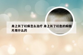 身上长了红癣怎么治疗 身上长了红色的癣图片用什么药