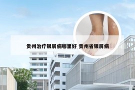 贵州治疗银屑病哪里好 贵州省银屑病