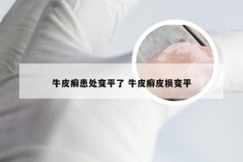 牛皮癣患处变平了 牛皮癣皮损变平