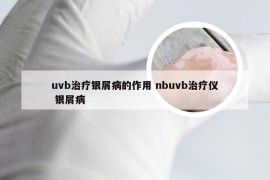 uvb治疗银屑病的作用 nbuvb治疗仪 银屑病