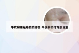 牛皮癣用经络拍拍哪里 牛皮癣拍打背部治愈