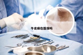 牛皮癣在医保吗