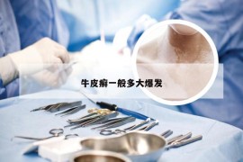 牛皮癣一般多大爆发