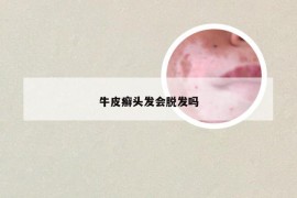牛皮癣头发会脱发吗