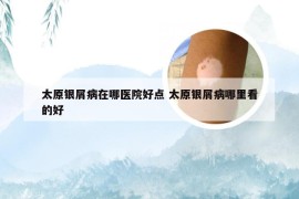 太原银屑病在哪医院好点 太原银屑病哪里看的好
